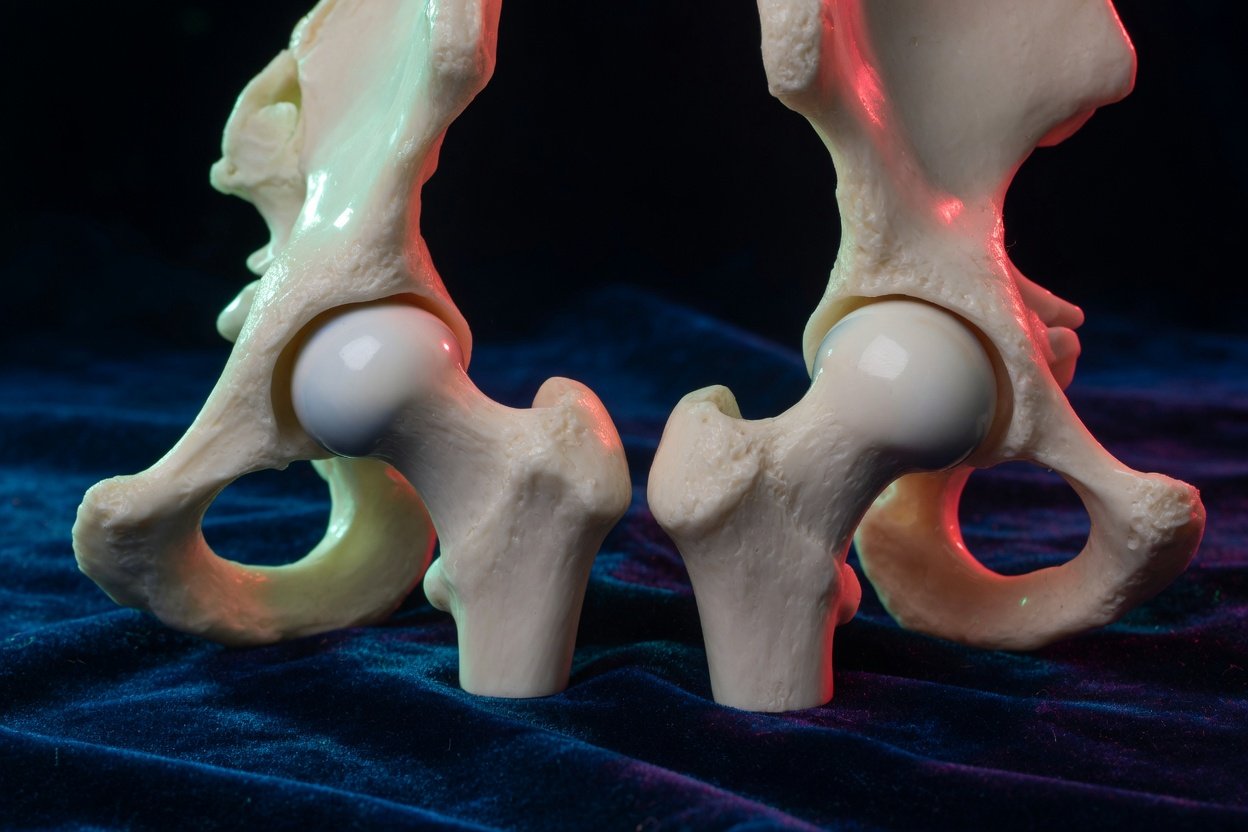 Hip models comparing a rounded femoral head with one showing flattening
